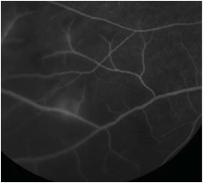 normal retina on fundoscopy
