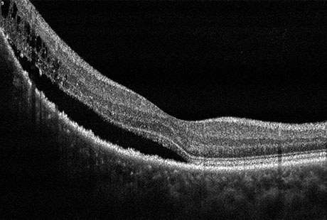 serous retinal detachment oct