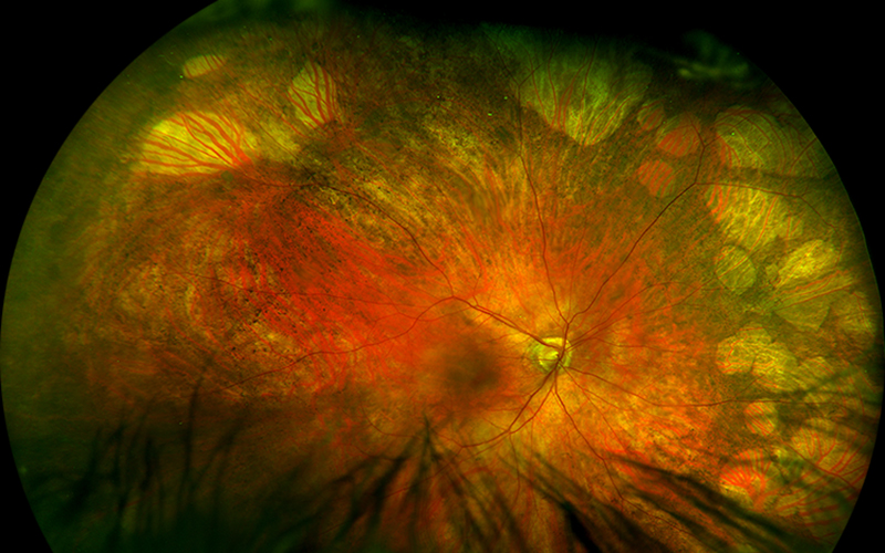 West Coast Retina Case of the Month May, 2022