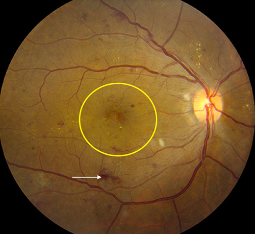 swelling in retina due to diabetes