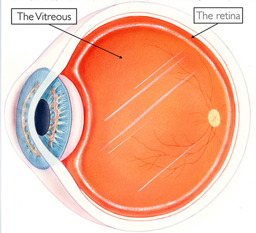 vitreous syneresis treatment